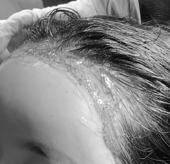 Faster wound healing with EGF care