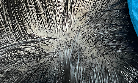 NEWHAiR's unique know-how helps create the
appearance of real hair growth