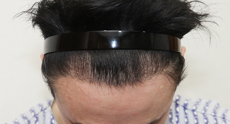 Density increase after hair transplantation