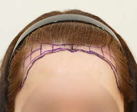 성형외과 의사 선생님이 개인의 비율과 모양을 분석하여 맞춤형 디자인합니다