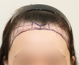 성형외과 의사 선생님이 개인의 비율과 모양을 분석하여 맞춤형 디자인합니다