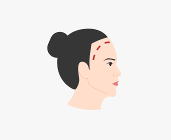 절개 헤어라인교정