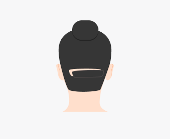 절개 헤어라인교정