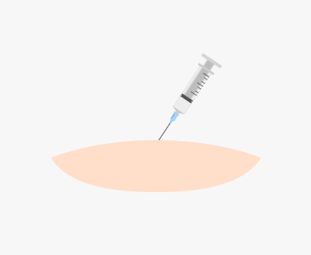 절개 헤어라인교정
