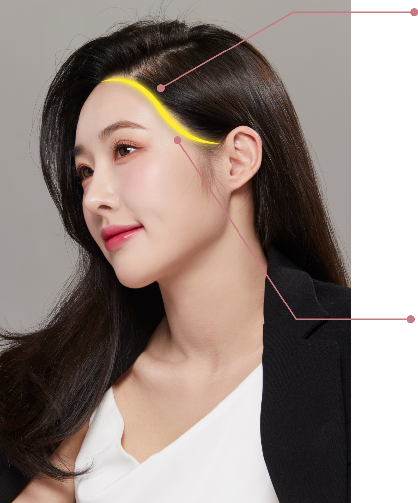 S라인 헤어라인 교정