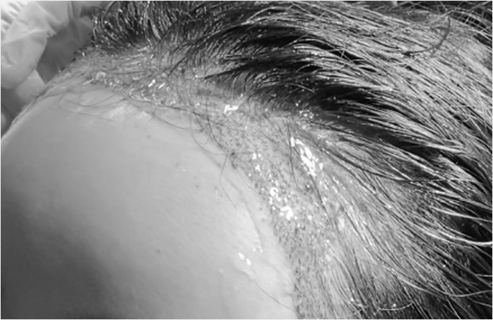 After hairline correction, gels and sprays containing EGF are used to help scar tissue heal quickly and cleanly, quickly reducing redness so you can get back to your daily routine.