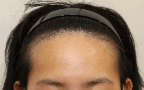 얼굴형, 헤어라인에 구애 없이 완성하는 맞춤형 라인