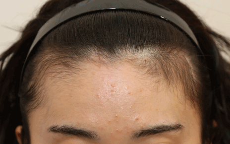 얼굴형, 헤어라인에 구애 없이 완성하는 맞춤형 라인