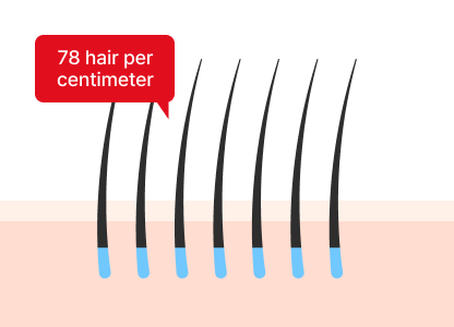 hair transplant
