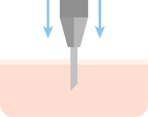 Create pores at the transplant site