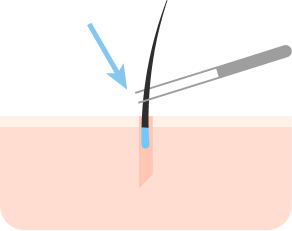 Insert hair follicles into pores