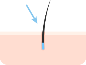 Accurate transplant with less scarring