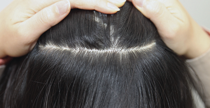 Incisional hair transplant scars