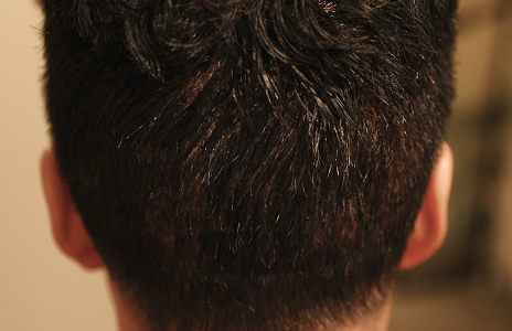 The day after surgery (after shampooing)