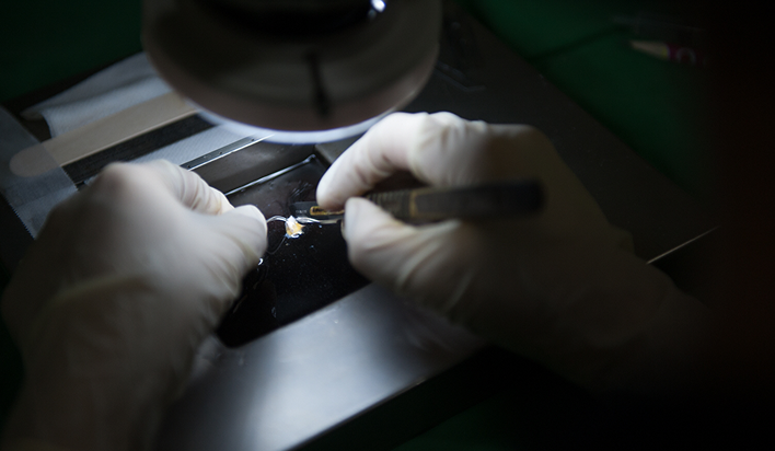 Transplanted hair follicle aqua cutting