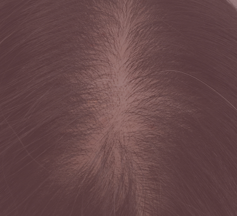 Female hair loss