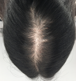 Crown/part diffuse hair loss