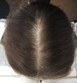 Postpartum hair loss