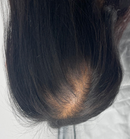 Menopausal hair loss