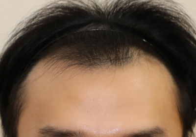 M-shaped hair loss