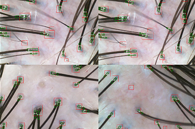 AI microscope hair loss test