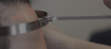 Hair transplant(Hairline correction)